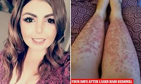 Laser hair removal can be. Woman S Body Reacted With Huge Hot Hives After Laser Hair Removal Procedure Daily Mail Online