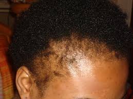 All you need to do is combine one teaspoon of pure aloe vera gel to two teaspoons of ground saw palmetto powder. 4 Easy Ways To Keep And Grow Back Your Edges Thepuffcuff