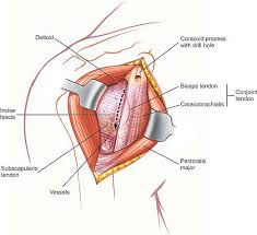Labral tears in the shoulder can cause pain, instability of the joint, or. The Shoulder Musculoskeletal Key