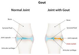 Image result for gout symptoms knee