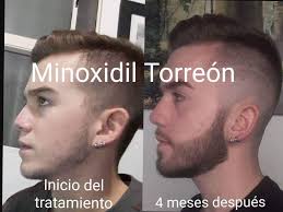 Tú también quieres una barba? ¡Envíanos un inbox! Minoxidil Kirkland y  foligain al mejor precio🧔🏻