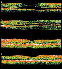 We did not find results for: Foveal Detachment After Successful Retinal Reattachment For Macula On Rhegmatogeneous Retinal Detachment An Ocular Coherence Tomography Evaluation Eye
