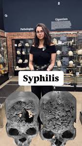 Image result for Tertiary Syphilis