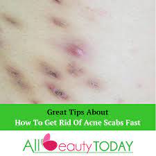How to get rid of acne scabs overnight? How To Get Rid Of Acne Scabs Fast 3 Method For You