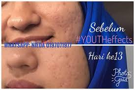 Berikut adalah 3 produk yang boleh digunakan untuk hilangkan parut hitam di muka: Cara Hilangkan Parut Jerawat Untuk Wajah Kembali Cantik Ohcantik Com
