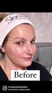 #skinpen #skinpenmicroneedling #aesthetics #glasgowtiktok #glasgow  #skinpenprecision #skinglasgow #40something #antiageing  #collageninductiontherapy