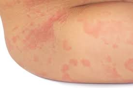 Image result for allergy rash on the legs