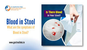 Image result for Blood in stool