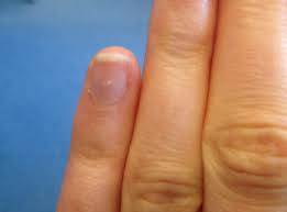 Alltagsfrage Was Bedeuten Weisse Flecken Auf Den Fingernageln Kolnische Rundschau