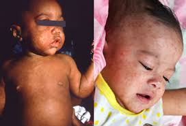 Image result for measles