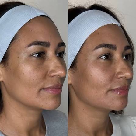 Skin Rejuvenation Before