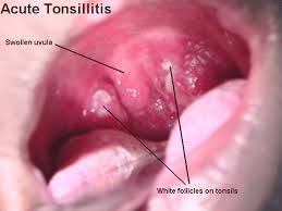 medical images appearance of normal tonsils and inflamed