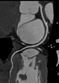 Ct Coronary Calcium Score Indicates Long Term Heart Health