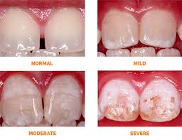 Dental Fluorosis Pediatric Dentist
