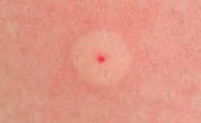 Only a red mark, local swelling, and itchiness. How To Recognize The 10 Most Common Insect Bites 12 Tomatoes