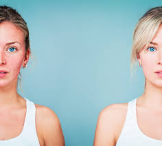 For others, these lines are permanent features of the face, even when the face is at rest. Crow S Feet 4 Tips For How To Get Rid Of Crow S Feet Eyes Colorescience