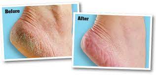 Are usually extremely dry with cracks i used this cream for 10 days and got awesome results. O Keeffe S Healthy Feet Foot Cream Cracked Feet Relief O Keeffe S Uk