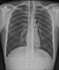 The pleura is a slim membrane that covers the lungs. Spontaneous Pneumothorax Radiology Case Radiopaedia Org