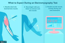 Electromyography Uses Side Effects Procedure Results