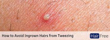 The best way to reduce the incidence of ingrown hairs is to stop tweezing, plucking, and waxing the hairs until the ingrown hair has made its way out by itself or with the help of a professional. How To Avoid Ingrown Hairs From Tweezing Hair Free Life