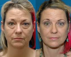 Face Lift Seattle Face Lift Specialist Right after i got pregnant with my son i was diagnosed with hypothyroidism which is when your thyroid gland doesn't produce enough thyroid hormones, then a little after i was diagnosed with thyroid cancer and had to get my thyroid removed. face lift seattle face lift specialist