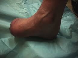 Mohd hazim bin abdullah medical officer, wound team hospital duchess of kent, sandakan wound care manual, first edition 2014 2. Current Concepts In Diabetic Foot Surgery Podiatry Today Hmp Global