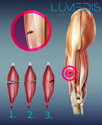 Objective surgical refixation intends to restore the continuity of the hamstrings and anatomically reattach the torn tendons. Schmerzen Am Hinteren Oberschenkel Lumedis Orthopaden