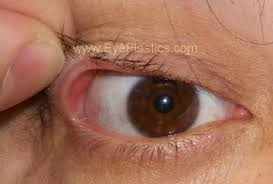 The eyelids have many functions, including protecting and lubricating the eye. Floppy Eyelid Syndrome Eye Lid Laxity Ectropion Entropio Floppy Eyelid Laxity Trichiasis