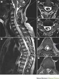 Image result for Spinal Trauma