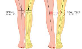 Bow Legs (Genu Varum) – Correction | Mount Elizabeth Hospitals