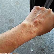 Mother Of Three Who Had A Deadly Allergy To The Cold Is Cured Cold Or Allergies Cold Urticaria How To Reduce Pimples