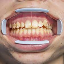 Some remedies include whitening toothpaste, activated charcoal whitening, whitening strips, apple cider vinegar, and good ol' fashion baking soda. Get Rid Of Those Embarrassing White Spots On Your Teethhartrick Dentistry Royal Oak Michigan Cosmetic Dentist