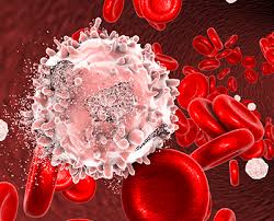 Le leucemie croniche si differenziano dalle acute per l'insorgenza dei sintomi e dei segni che è meno. Que Es La Leucemia Mieloide Cronica Lmc