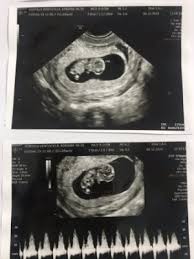 Eco De 8 Semanas Nino O Nina Ecografias Babycenter
