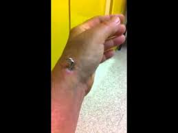 Maybe you would like to learn more about one of these? Dead Skin Under Cast