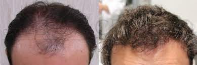 Autotrapianto di capelli a torino milano. Autotrapianto Di Capelli Fut Fue Evitare La Calvizie