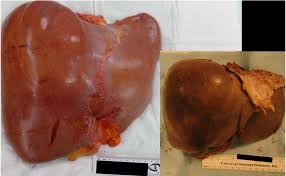 Congestive Hepatomegaly-Hepatomegaly-Causes-Symptoms-Diagnosis-Treatment Optins-Dr-Qaisar-Ahmed-A Haytham Clinic-Risalpur-KPK-Pakistan