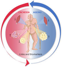 Image result for Cachexia in Cancer