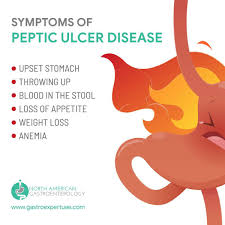Symptoms Of Peptic Ulcer Disease In 2020 Ulcers Peptic Ulcer Disease