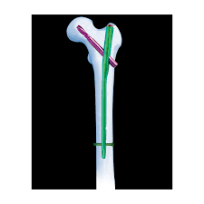 PFNA Proximal Femoral Nail Antirotation,Spiral Blade With ...