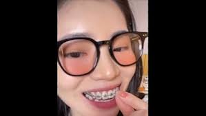 Orthodontic Wax for Braces, Orthodontic Relief Wax, Dental Wax Braces  Support Wax, Braces Wax, for Braces Wearers : Amazon.de: Health & Personal  Care