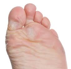 Calluses occur due to various reasons on both feet and hands. Callus On Bottom Of Your Foot Why And How To Prevent Them