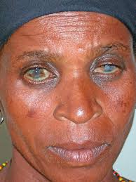 Image result for Vernal Conjunctivitis