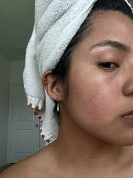 Hey girlys! I'm wondering if anyone has gone through this. For context,  both of my parents have skin discoloration