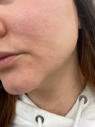 Does avoiding gluten help with dermatitis herpetiformis?