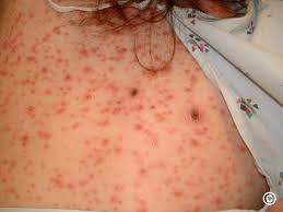 Image result for syphilis symptoms