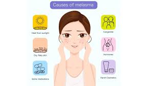 Image result for Melasma