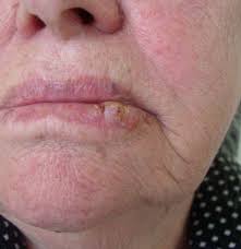 Cumulative sun exposure causes mainly basal cell and squamous cell skin cancer, while episodes what are the signs and symptoms of skin cancer? Lip Cancer What It Looks Like And What To Do