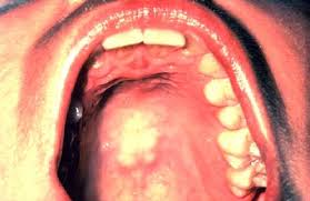 Image result for Physical injury red spots roof of mouth