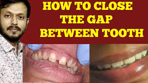 How to do diastema closure | how to fix a teeth gap with or without braces? à¤¦ à¤¤ à¤• à¤¬ à¤š à¤• à¤— à¤ª à¤• à¤­à¤°à¤¨ à¤• à¤‡à¤² à¤œ Tooth Gap Filling Front Teeth Teeth Gap Treatment Hindi Youtube